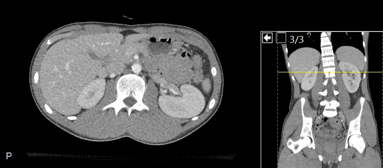 Real axial abdominal CT image, viewed from the feet towards the head