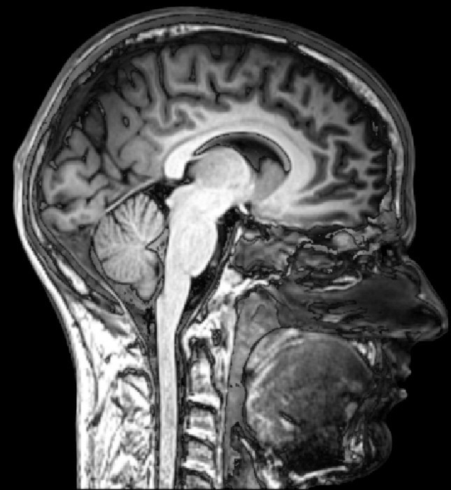 Real sagittal brain MRI