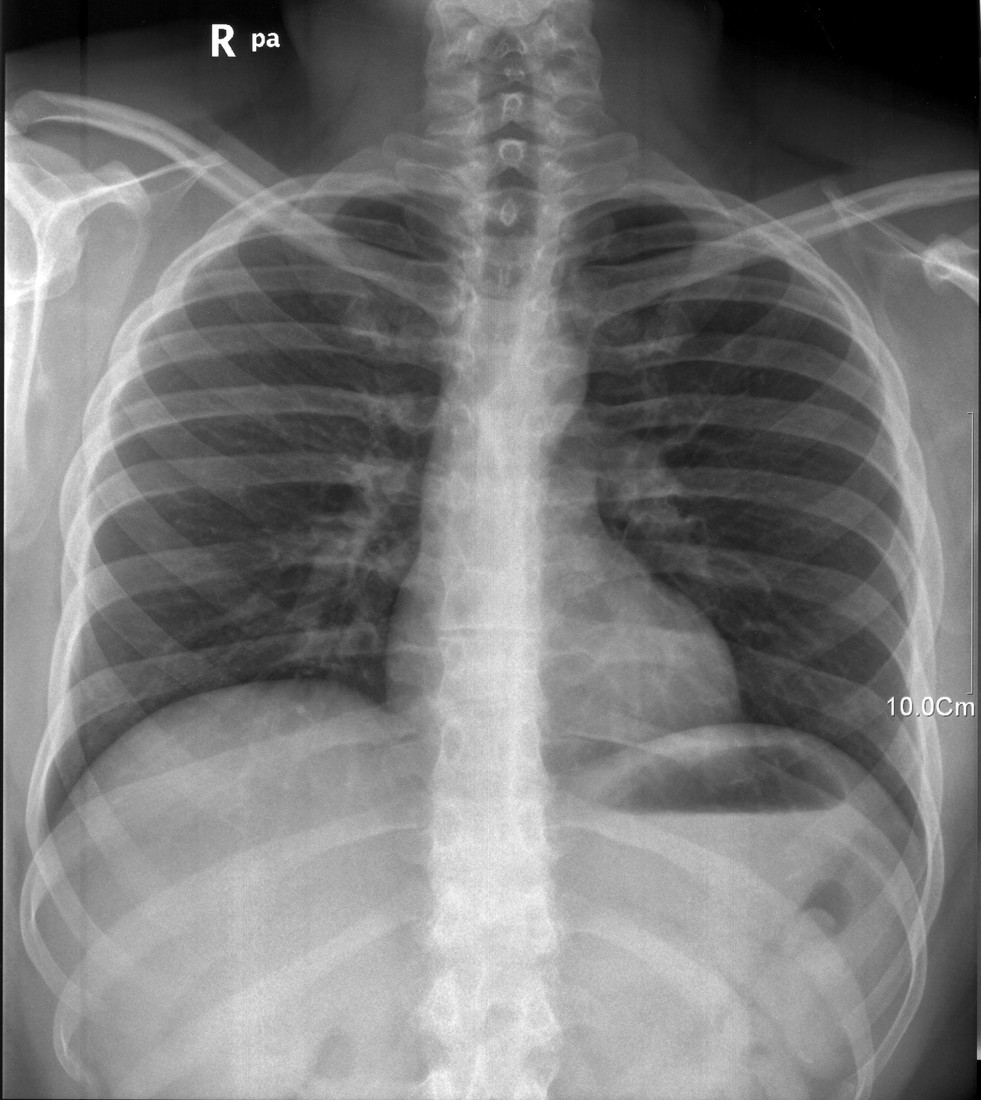 Real frontal chest radiograph showing the ribs, lungs and cardiac silhouette